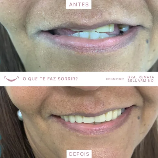 Resultado procedimento com a Dra. Renata Bellarmino.