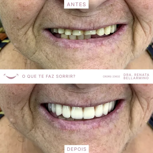 Resultado procedimento com a Dra. Renata Bellarmino.