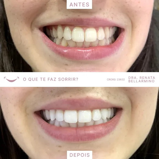 Resultado procedimento com a Dra. Renata Bellarmino.