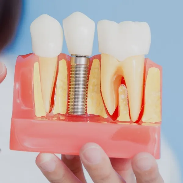 Serviço de Implante Dental com Dra. Renata Bellarmino.